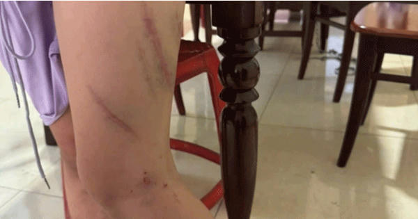 Con gái 9 tuổi nghi bị mẹ ruột tác động vật lý 34 vết bầm