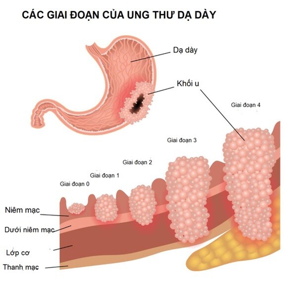 Ung thư dạ dày có thể điều trị khỏi nếu được phát hiện ở giai đoạn sớm. Ảnh minh họa