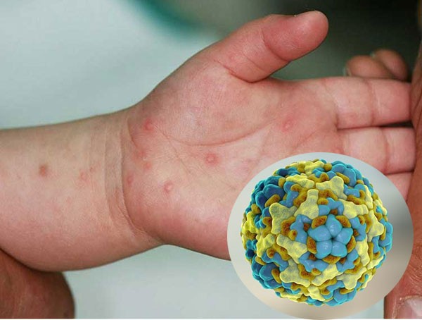 Cảnh báo dịch tay chân miệng “vào mùa Dịch chân tay miệng gia tăng, đối tượng chủ yếu mắc phải là trẻ nhỏ, hệ miễn dịch chưa đủ đề kháng.