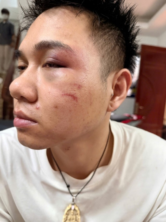 Tài xế xe công nghệ bị hành hung tím mắt vì từ chối chở khách say. Tài xế xe công nghệ bị hành hung tím mắt vì từ chối chở khách say.