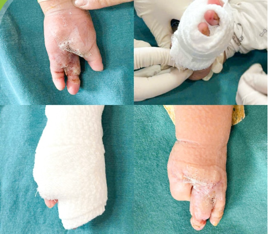 Hình ảnh bàn tay trẻ sau hơn ba tuần điều trị. (Ảnh: Bệnh viện Nhi Trung ương)