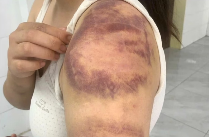 Phần tay bầm tím của cháu T. (Ảnh: Công an Bắc Ninh). Phần tay bầm tím của cháu T. (Ảnh: Công an Bắc Ninh).