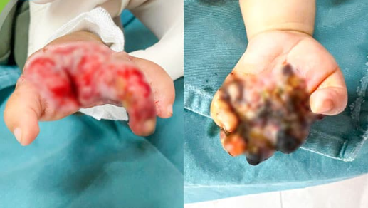 Bàn tay trẻ tại thời điểm nhập viện và sau khi phẫu thuật. (Ảnh: Bệnh viện Nhi Trung ương)