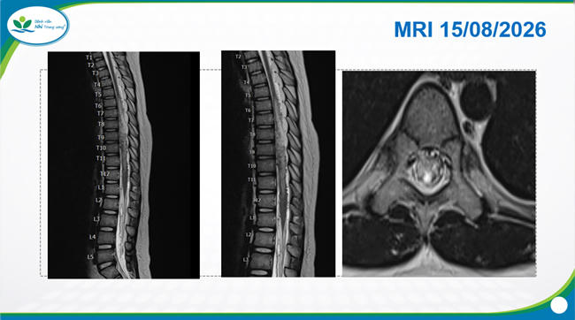 Hình ảnh phim chụp cộng hưởng từ của bé B.M. (Ảnh: Bệnh viện Nhi Trung ương)